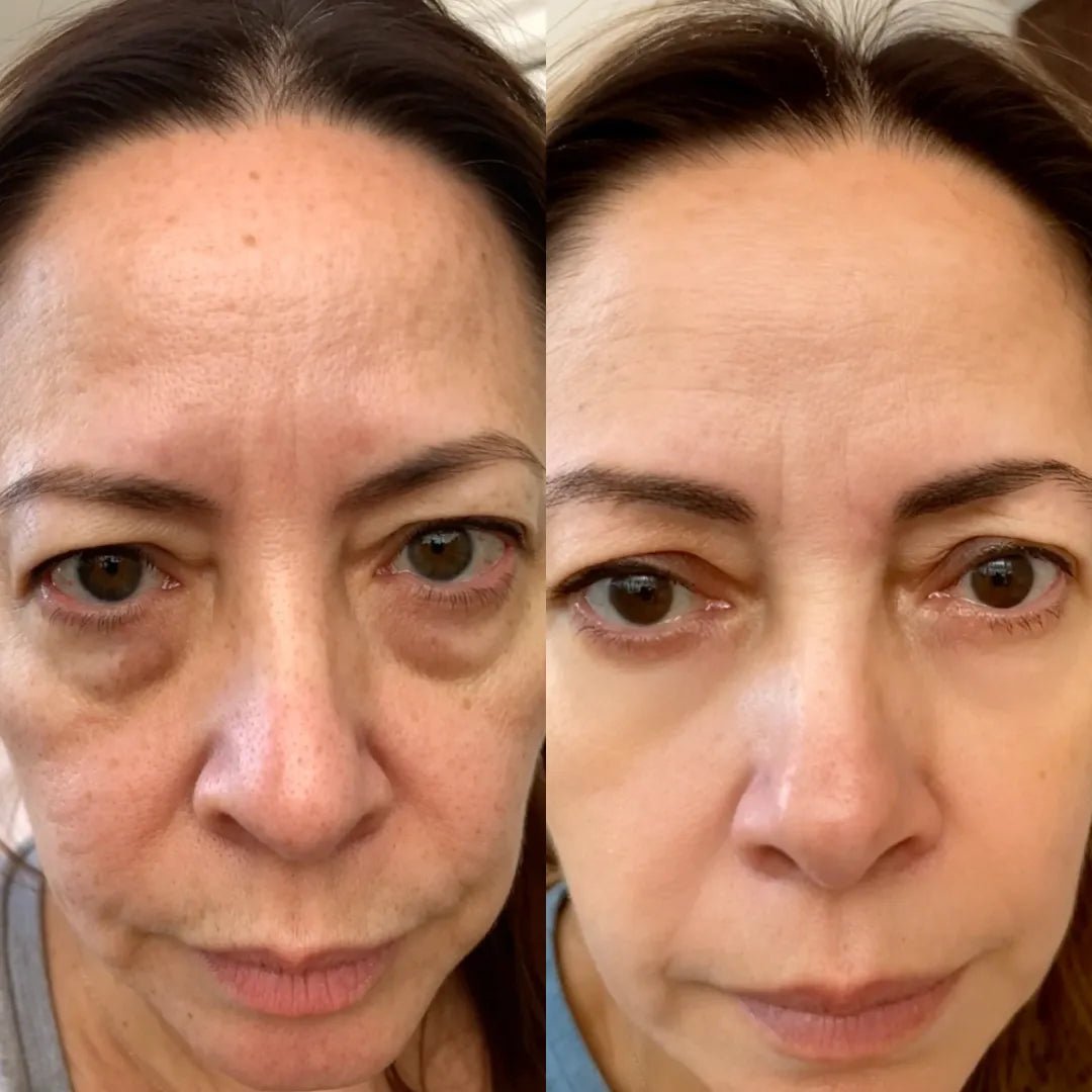 luminien™ Eye Bag Therapy