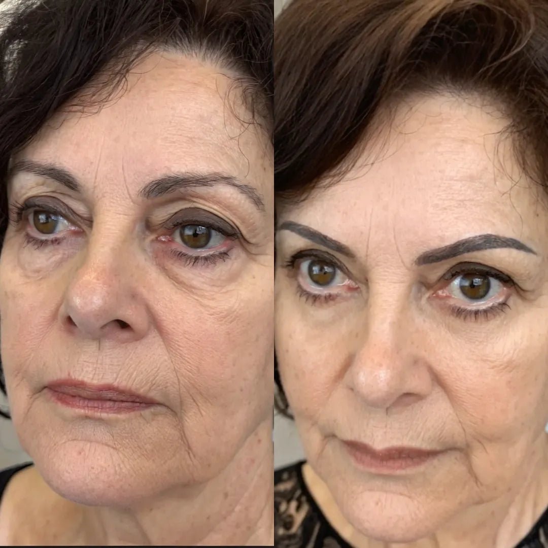 luminien™ Eye Bag Therapy